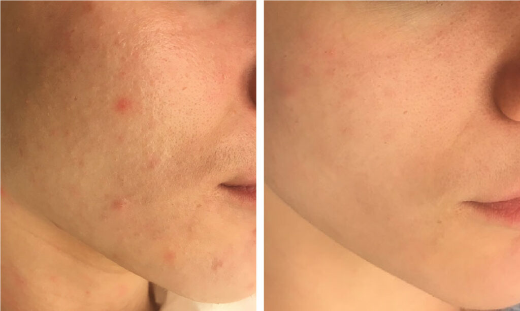 Professional peels: A complete guide for aesthetic professionals